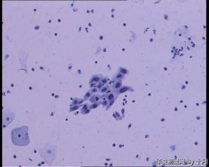 25岁，宫颈液基（HPV18、HPV58阳性）图3