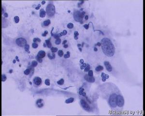 25岁，宫颈液基（HPV18、HPV58阳性）图10