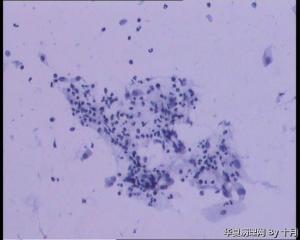 25岁，宫颈液基（HPV18、HPV58阳性）图9