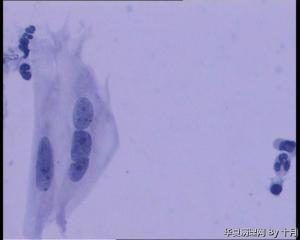 25岁，宫颈液基（HPV18、HPV58阳性）图8