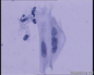 25岁，宫颈液基（HPV18、HPV58阳性）图12