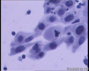 25岁，宫颈液基（HPV18、HPV58阳性）图5