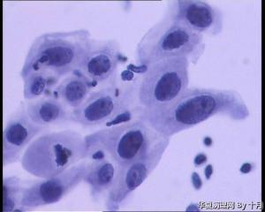 25岁，宫颈液基（HPV18、HPV58阳性）图4