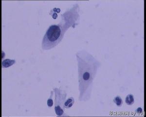 25岁，宫颈液基（HPV18、HPV58阳性）图2