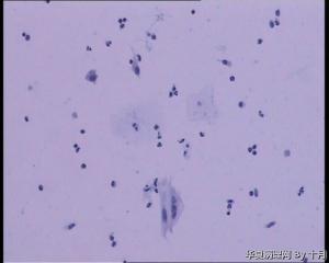 25岁，宫颈液基（HPV18、HPV58阳性）图11