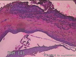 中耳病变组织图21