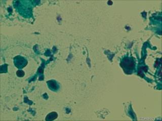 55岁绝经，宫颈口赘生物。这样的片子不会看！图19