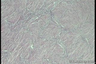 卵巢卵泡膜细胞瘤吗？图2