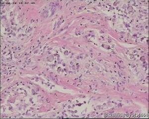 老师们帮忙看一下，是不是腱鞘巨细胞瘤，谢谢图8