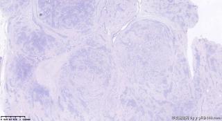 乳房包块30年，纤维腺瘤中增生的是什么细胞？图1