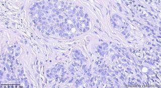 乳房包块30年，纤维腺瘤中增生的是什么细胞？图8