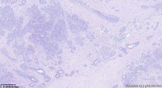 乳房包块30年，纤维腺瘤中增生的是什么细胞？图2