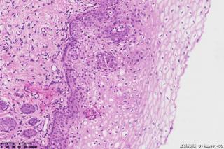 宫颈组织，高危险HPV16型阳性图19