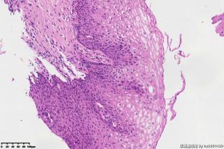 宫颈组织，高危险HPV16型阳性图14