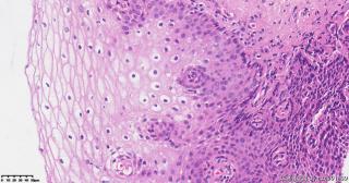 宫颈组织，高危险HPV16型阳性图3