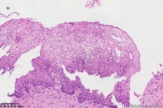 宫颈组织，高危险HPV16型阳性图15