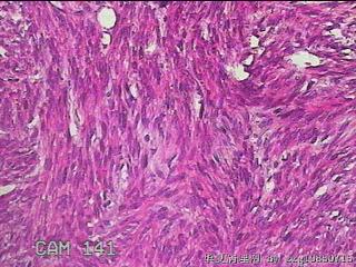次全子宫及肌瘤图43