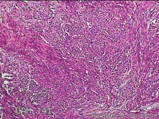 次全子宫及肌瘤图17
