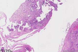 宫颈组织，高危险HPV16型阳性图21