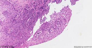 宫颈组织，高危险HPV16型阳性图4