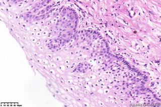 宫颈组织，高危险HPV16型阳性图10