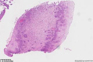 宫颈组织，高危险HPV16型阳性图18