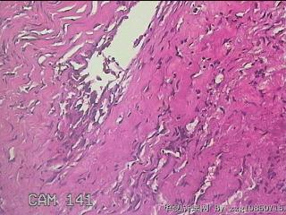 盆腔粘连组织图24