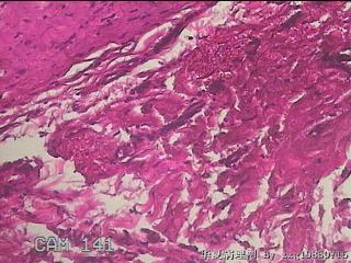 盆腔粘连组织图43