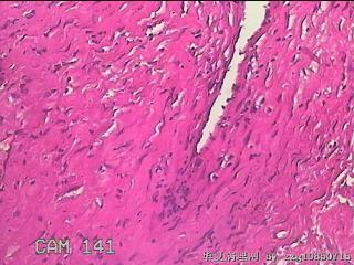 盆腔粘连组织图33