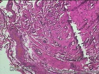 盆腔粘连组织图18