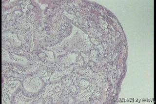 请老师看看宫颈息肉，个别上皮细胞异型图8