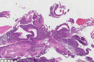 鼻咽部囊性新生物图23