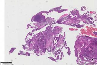 鼻咽部囊性新生物图15