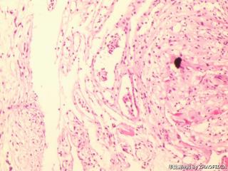 胸膜活检组织图19
