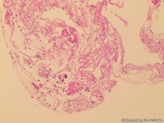 胸膜活检组织图11