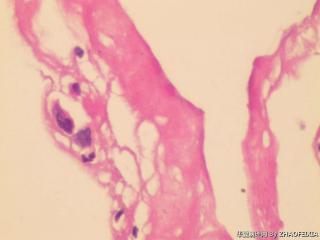 胸膜活检组织图17