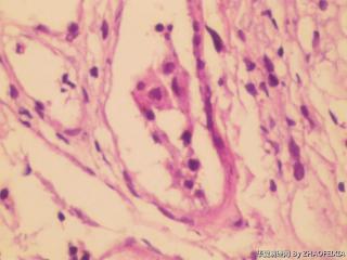 胸膜活检组织图20