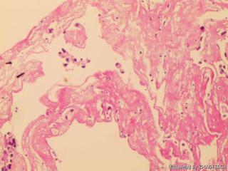 胸膜活检组织图10