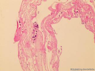 胸膜活检组织图9