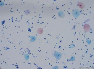 请老师看一下小细胞团，到底是正常还是ASC-H。图4