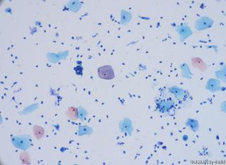请老师看一下小细胞团，到底是正常还是ASC-H。图16