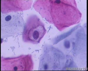 全片仅这两个挖空样细胞，怎么报？（HPV51阳性）图2