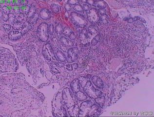 吻合口病变图6