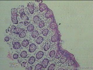 降乙结肠粘膜图9