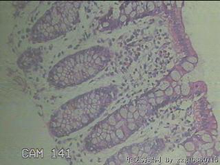 降乙结肠粘膜图18