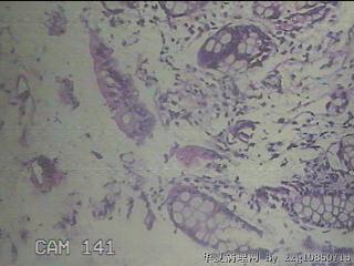 降乙结肠粘膜图26