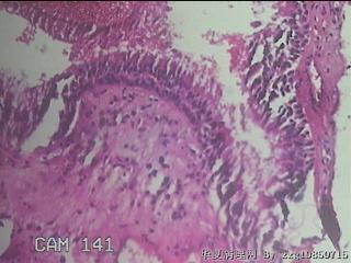 鼻腔新生物图31