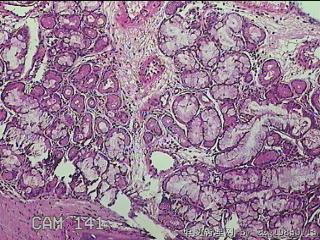 鼻腔新生物图6