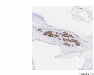 Neuroendocrine tumor arising in association with a mature cystic teratoma？请问有沒其他名字替代？图4