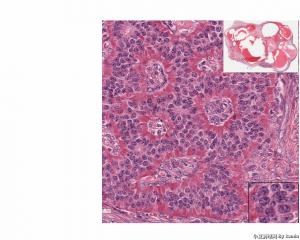 Neuroendocrine tumor arising in association with a mature cystic teratoma？请问有沒其他名字替代？图2